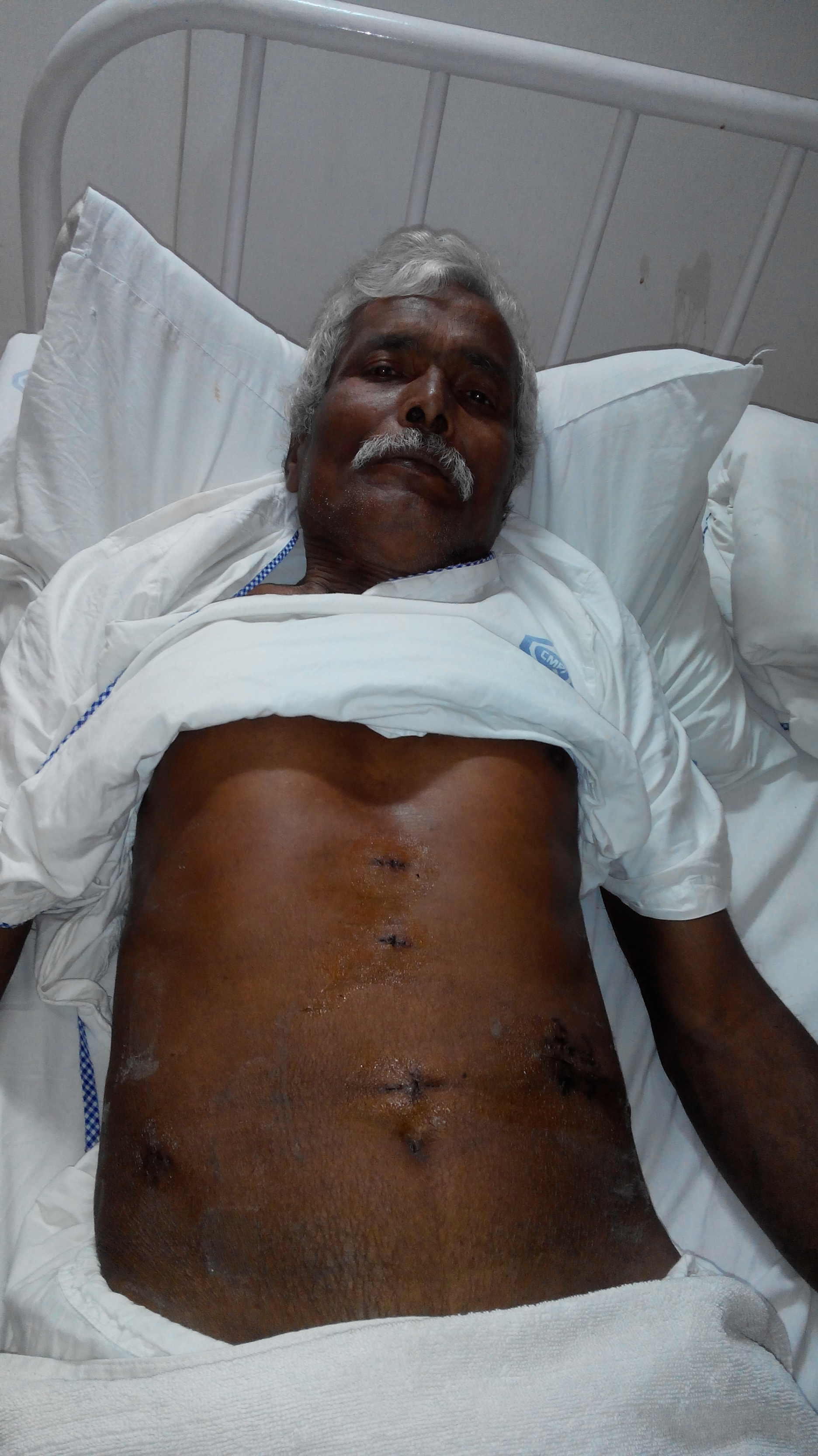 Splenectomy / hemoperitonum