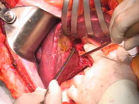 Liver Resection for Liver Tumor