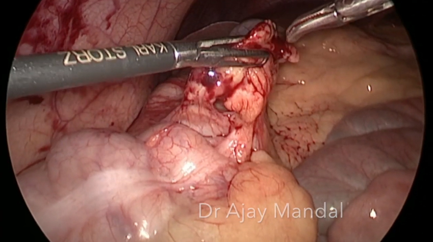 Torsion of Appendix Epiploica by Dr. Ajay Mandal