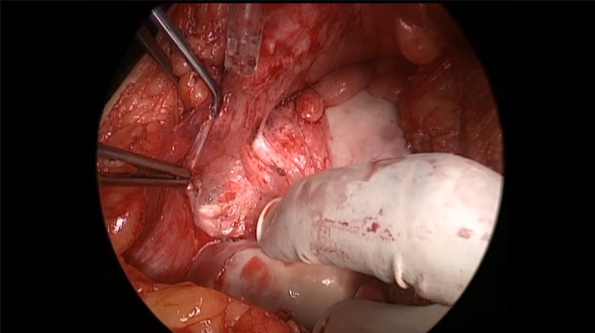 Abdominal Cocoon - SEP by Dr. Ajay Mandal