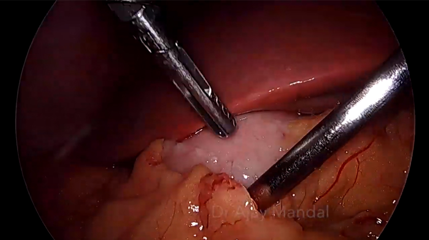 Use of ICG for Safe Laparoscopic cholecystectomy by Dr. Ajay Mandal