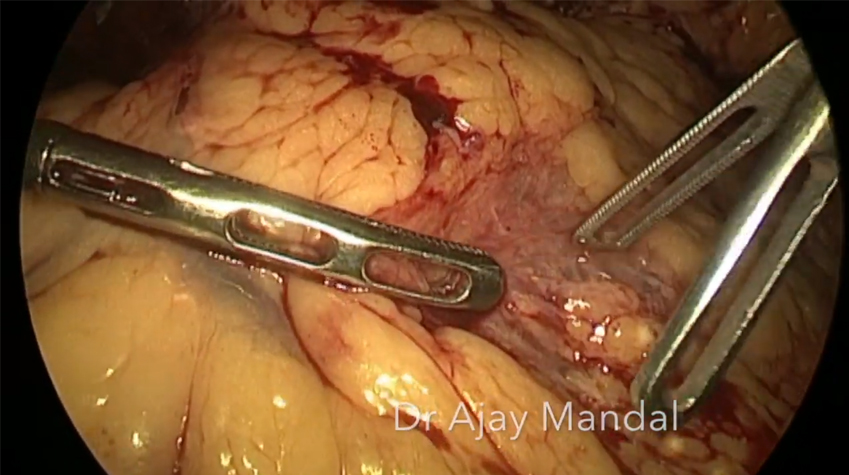 Laparoscopic Management of Infected Pancreatic Necrosis by Dr. Ajay Mandal