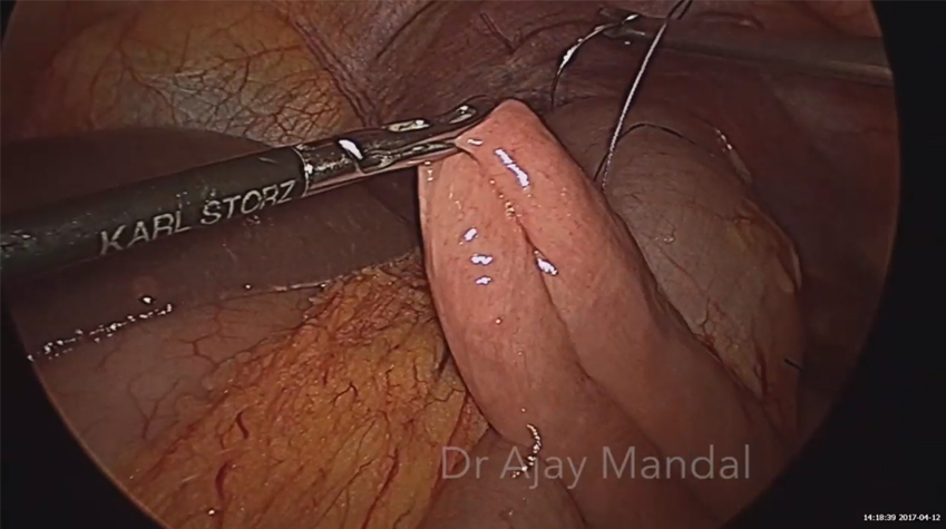 Laparoscopic Gastrojejunostomy (Lap GJ) by Dr. Ajay Mandal