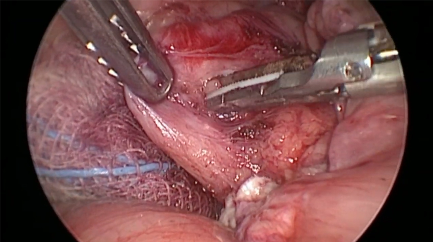 Retrocecal Appendectomy by Dr. Ajay Mandal
