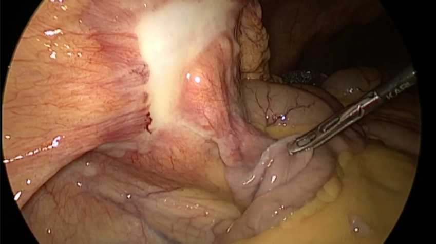 Laparoscopic assisted Right Hemicolectomy by Dr. Ajay Mandal