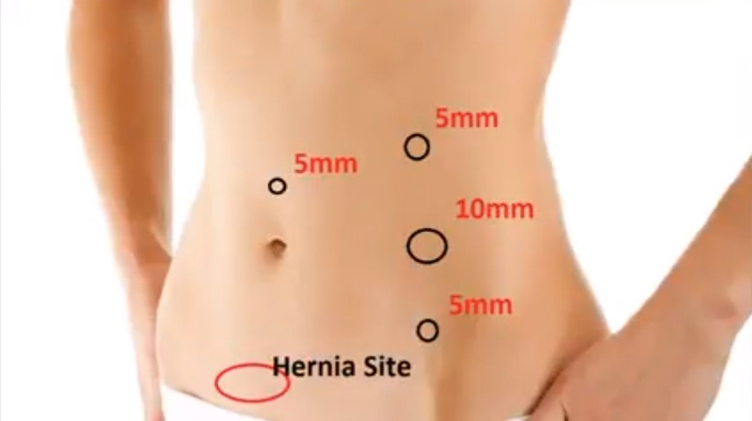Obstructed Ventral Hernia (Managed Laparoscopic) surgery by Dr. Ajay Mandal